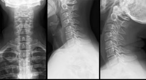 Функциональная флюорография шейного отдела позвоночника