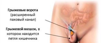 Образование в паховой складке во время беременности
