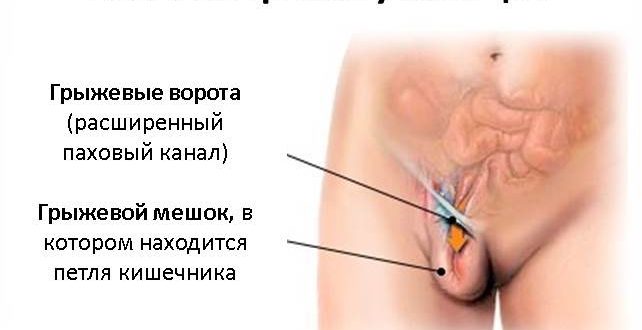 Образование в паховой складке во время беременности