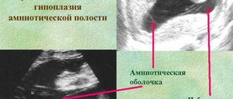 Гипоплазия амниотической полости?