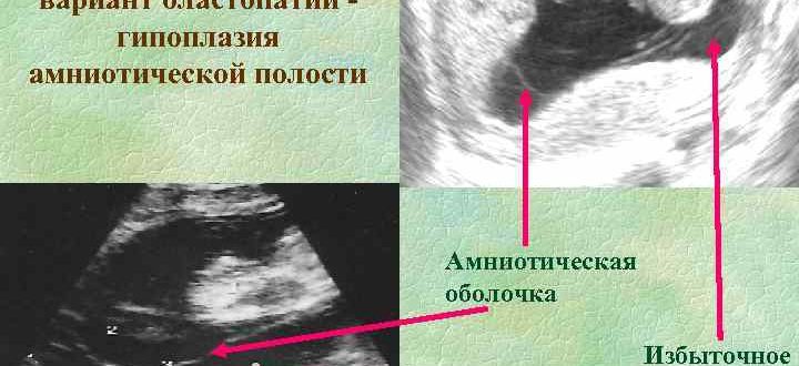 Гипоплазия амниотической полости?