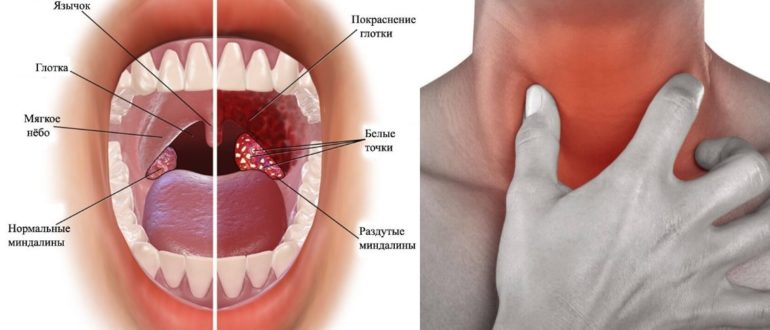 Горло чешется и красное