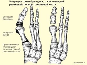 Операция Шэдэ-Брандеса