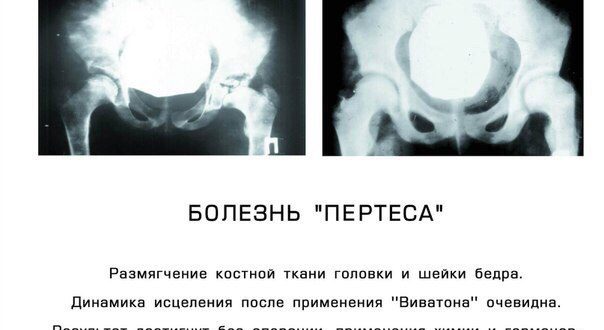 Односторонняя болезнь Пертеса, группа инвалидности