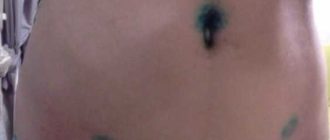 Отек лобка после лапароскопии