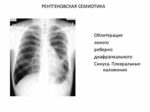 Передние кардиодиафоагмальные синусы облитерированы