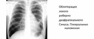 Передние кардиодиафоагмальные синусы облитерированы