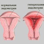 Отсутствие менструации больше трех месяцев