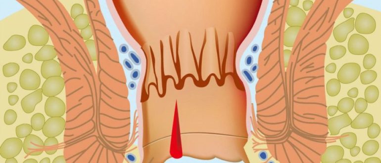 Хронические запоры и анальная трещина