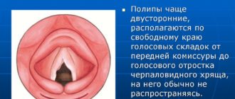 Гиперплазия гортани