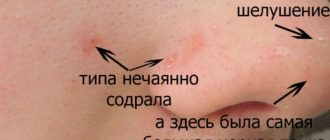 Нечаянно при умывании содрала прыщ