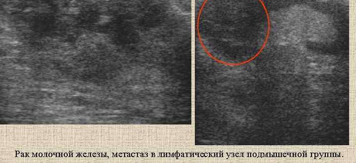 Гипоэхогенное образование в подмышечной области