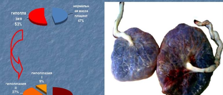 Гипоплазия плаценты