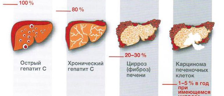 Гепатит С при онкологии что делать