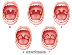 Одностороннее увеличение миндалины