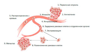 Онкология, рецедив, гиперактивное распространение опухоли