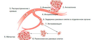 Онкология, рецедив, гиперактивное распространение опухоли