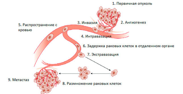 Онкология, рецедив, гиперактивное распространение опухоли