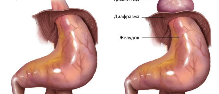 Грыжа пищевода 3-степени