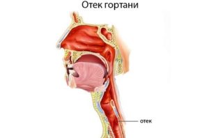 Печёт и отекает гортань