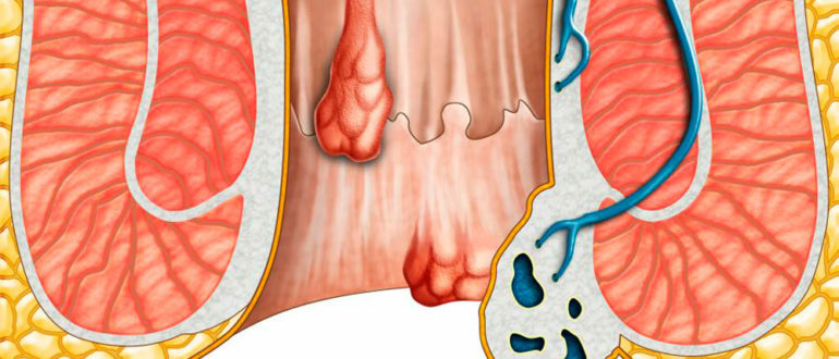 Геморрой