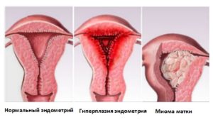 Гиперплазия эндометрия. Миома матки