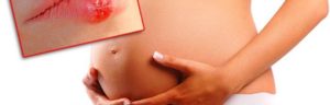 Герпес на 38 неделе беременности