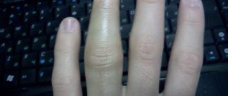 Не проходит отек после ушиба пальца