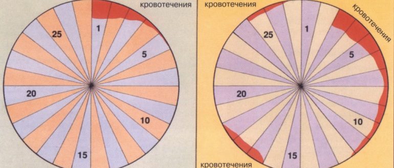 Нерегулярные менструации