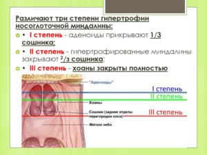 Гипертрофия аденоидов 1-2 степени, гипертрофия миндалин 2-3 ст