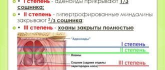 Гипертрофия аденоидов 1-2 степени, гипертрофия миндалин 2-3 ст