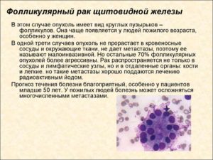 Нужна ли операция при атипии клеток щитовидной железы