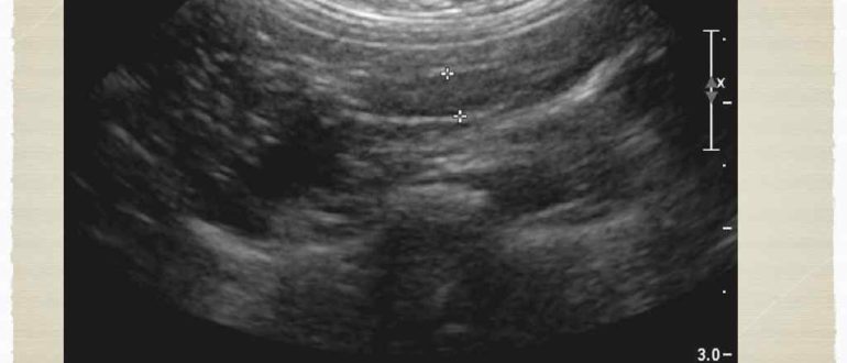Гипоэхогенное образование в левой подвздошной области