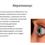 Глаукома и пилокарпин