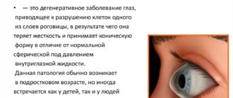 Передается ли кератоконус по наследству?
