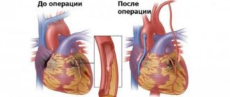 Перелёт после инфаркта