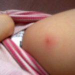 От чего может быть сыпь на руках у ребенка?