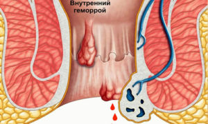 Опухоль в заднем проходе