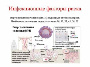 Хроническая болезнь матки, вирус паппиломы высокого онкогенного риска, эндометриоз