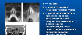 Гайморит и гемисинусит