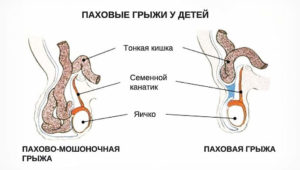 Паховая грыжа справа у девочки 5 лет