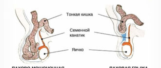 Паховая грыжа справа у девочки 5 лет