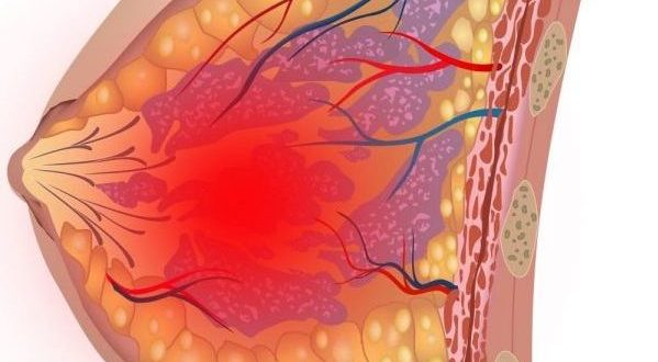 Гнойная киста молочной железы