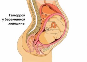 Геморрой при беременности 24-25 недель