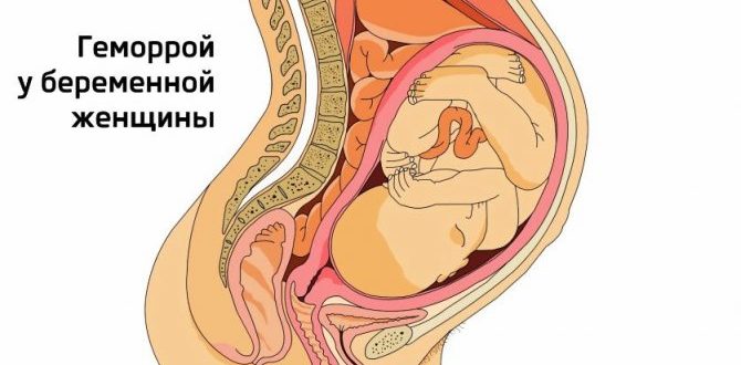 Геморрой при беременности 24-25 недель