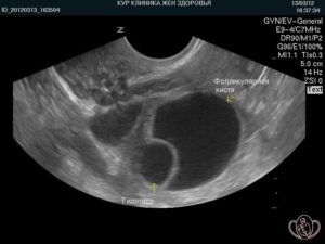 Фолликулярная киста 10см при беременности