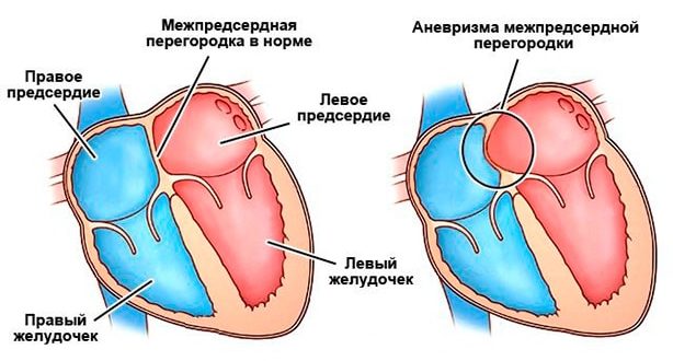 ООО (3мм), Аневризма МПП