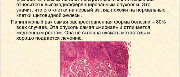 Папиллярный рак ЩЖ лечение после операции