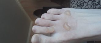 Ожог ноги 2 степени