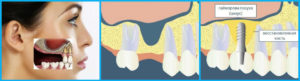 Гайморовые пазухи при стоматологической имплантации